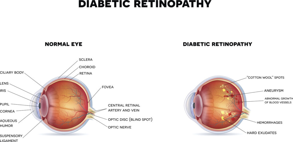 Diabetic retinopathy and healthy eye. The eye condition that affect people with diabetes.